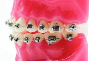 Incidents en orthodontie