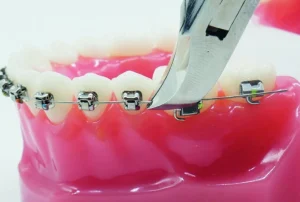 Incidents en orthodontie